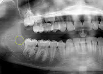 built in controls assures accurate dose delivery