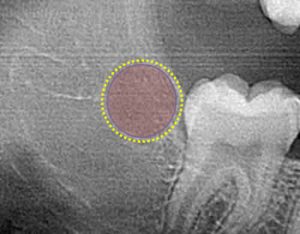 correctly ablated tooth bud
