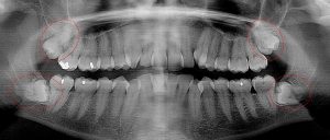 Immediate extraction of all four 3rd molars required