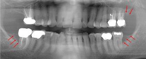 Loss of 2nd molars