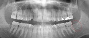 Unusually good post-op healing