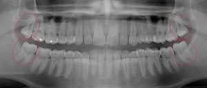 Fully erupted, hard to clean