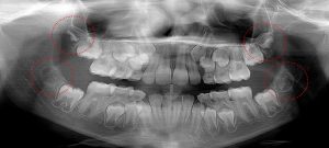 3rd molar tooth buds in very early stage of enamel formation