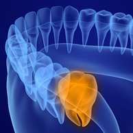 surgery-free way to remove molars